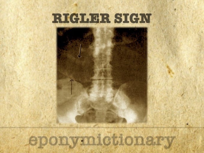 Rigler sign 680 2