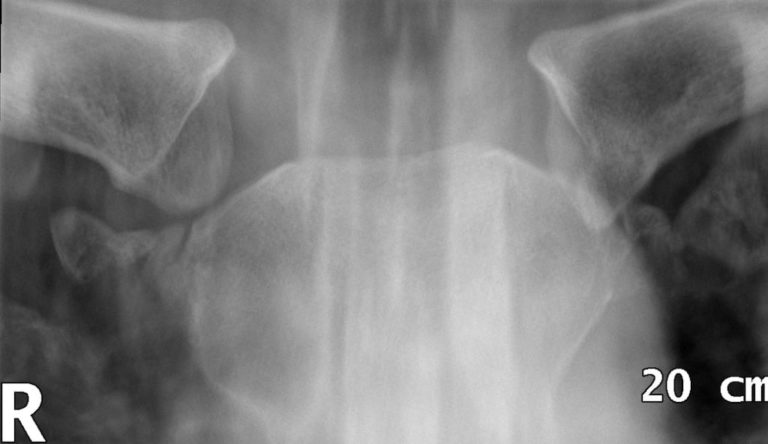Sternoclavicualr_Dislocation_002_L