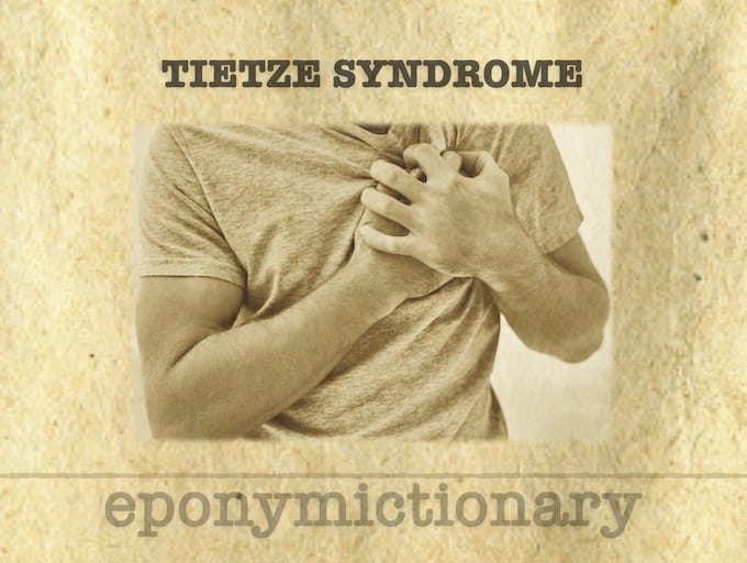 Tietze syndrome 680