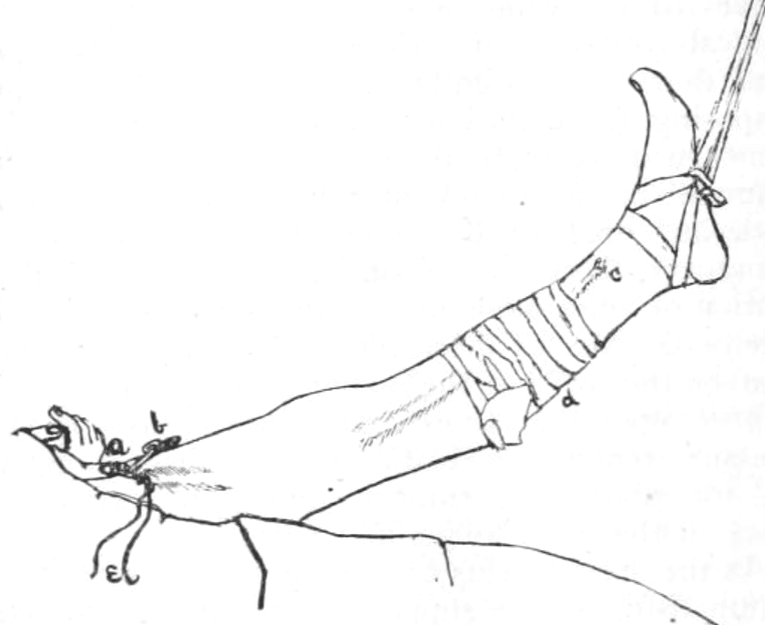 Babcock operation for varicose veins 1907