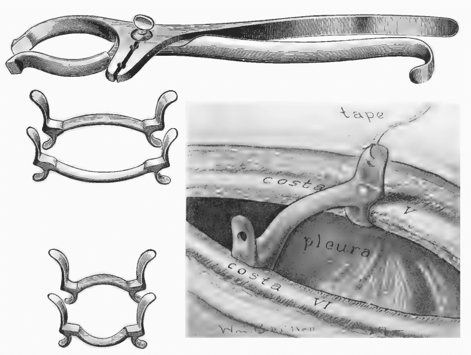 Babcock rib-spreader and props for major thoracoplasty 1928
