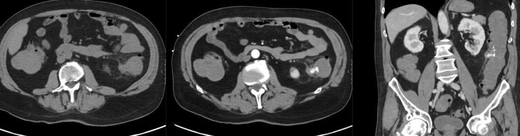 CT Case 106 Diverticular bleed