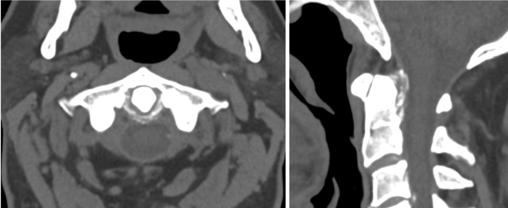 LITFL CT Case 105