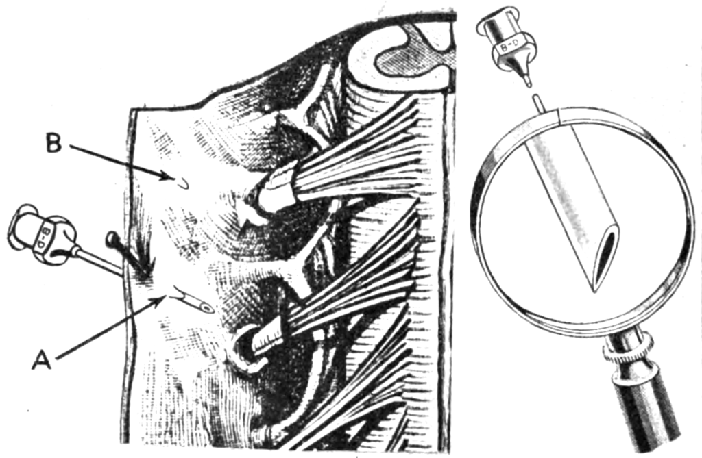 Pitkin Spinal needle 1927