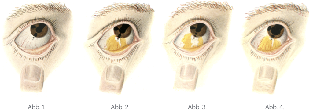 Seidel Test. Seidel’s fluorescein fistula test 1920